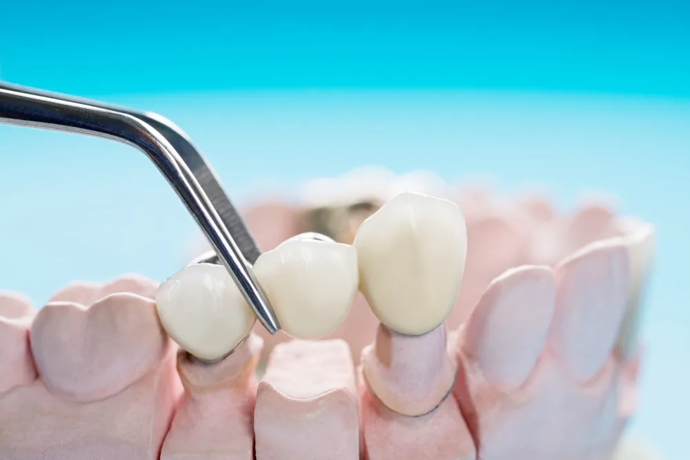 Dentist performing dental bridges procedure