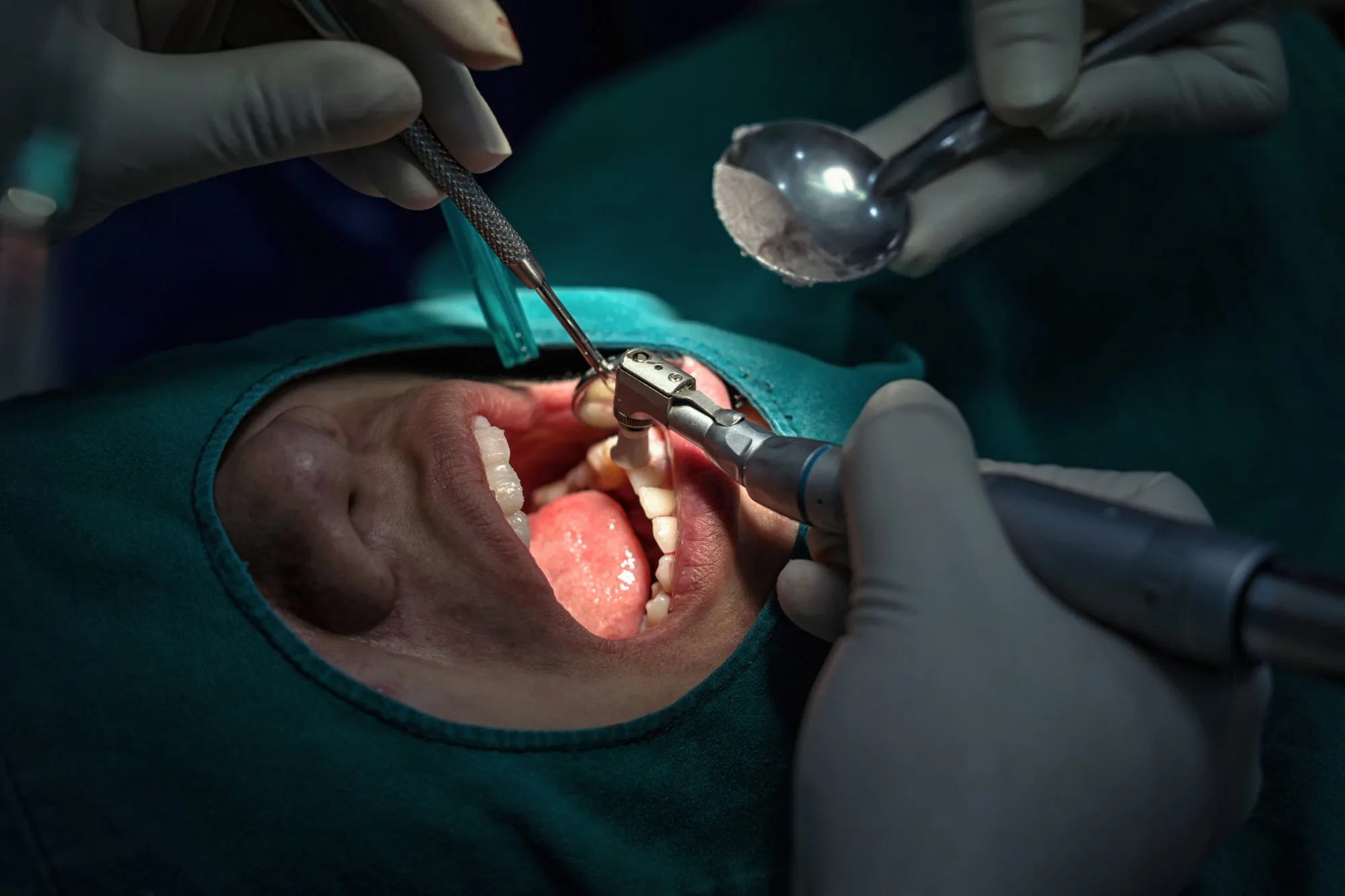 Laser-Assisted Gum Surgeries at Studio Dentale