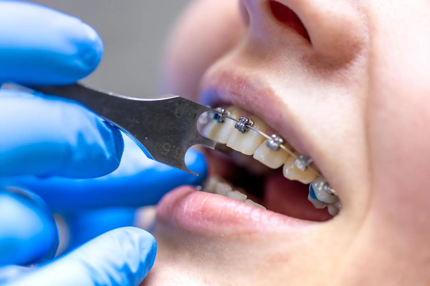 Dentist performing metal braces procedure