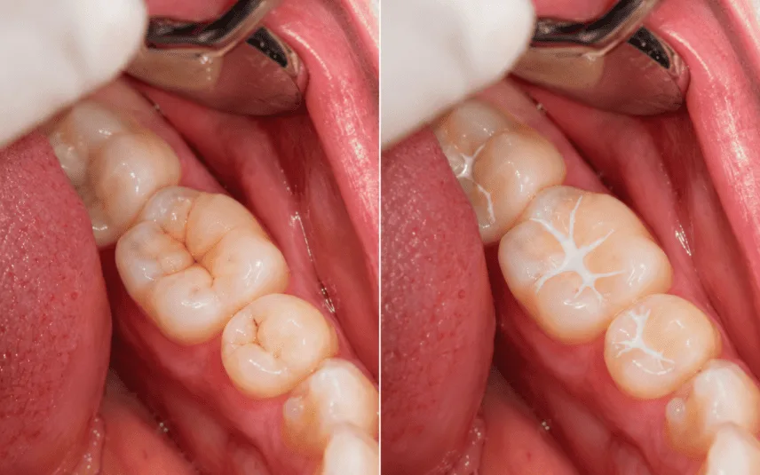 Dental Sealants at Studio Dentale