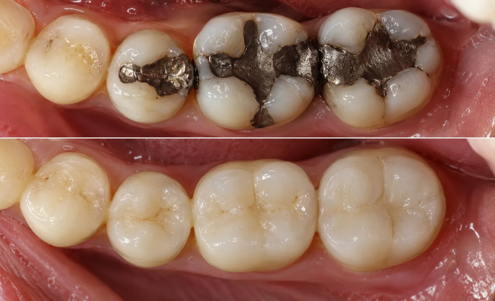 Dentist performing white fillings procedure
