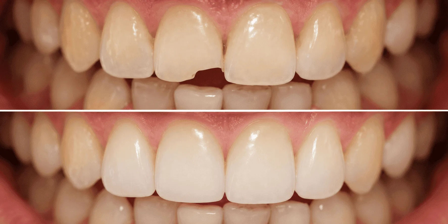 Dentist performing white fillings procedure