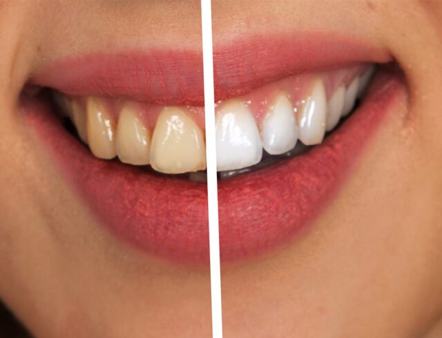 Tooth Whitening in Kathmandu, Nepal: Safe, Effective & Long-Lasting Results at Studio Dentale