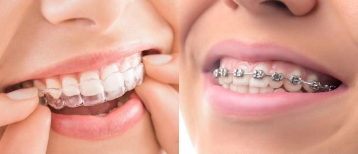 INVISALIGN OR BRACES? WHAT TO CHOOSE?