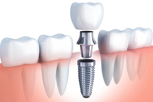 COMMON MISCONCEPTIONS ABOUT DENTAL IMPLANTS DEBUNKED