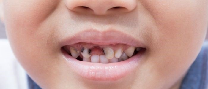 RECURRENT CAVITIES IN KIDS: PREVENTION & CARE AT STUDIO DENTALE
