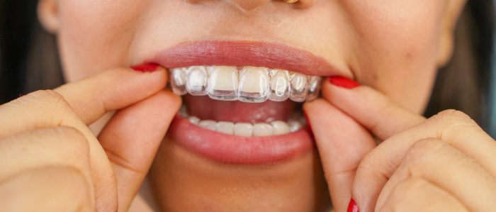 BEGIN YOUR ADULT ORTHODONTIC JOURNEY