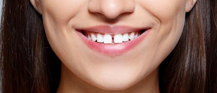 TOOTH GAP TROUBLE? STUDIO DENTALE HAS THE PERFECT FIX!