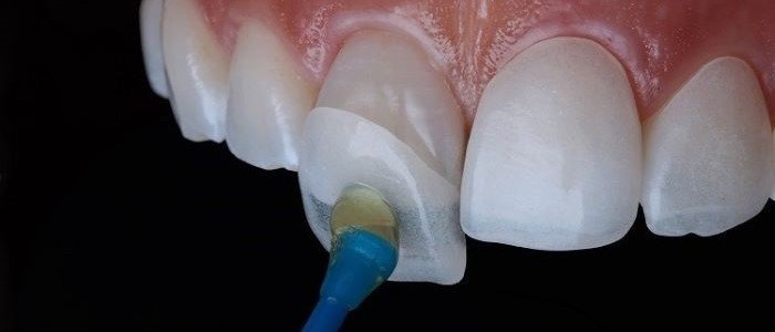 DISPELLING MYTHS ABOUT DENTAL VENEERS