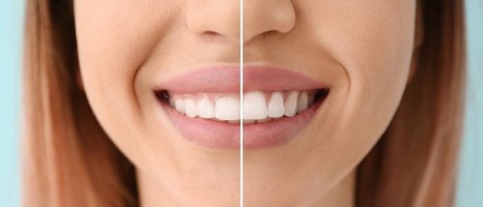 BENEFITS OF GUM CONTOURING: ACHIEVING A PERFECT SMILE