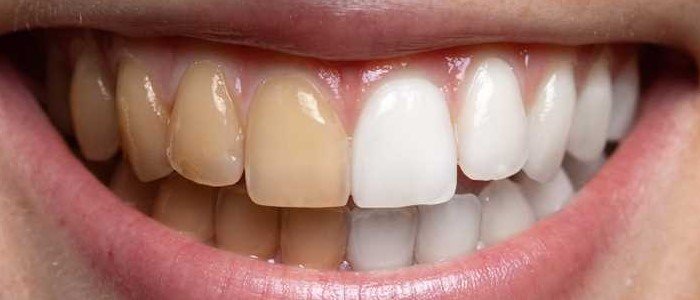 KNOW ABC’S OF TEETH STAINING