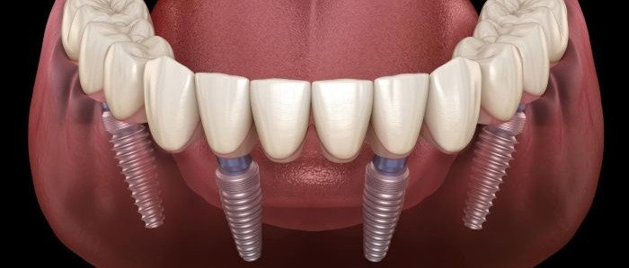 ALL-ON-4 DENTAL IMPLANTS IN KATHMANDU