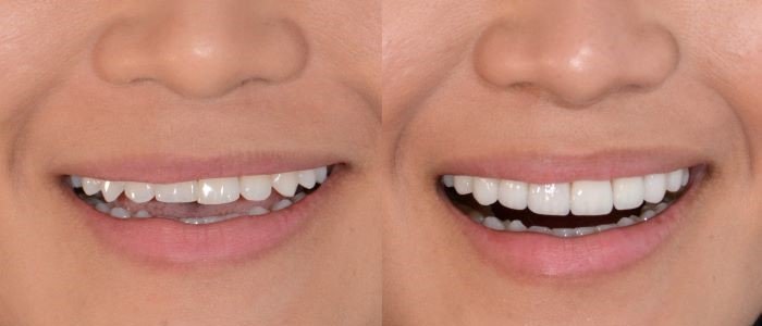 WHY CHOOSE DENTAL VENEERS AT STUDIO DENTALE