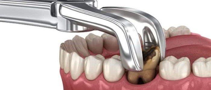 TIPS FOR A QUICK RECOVERY FROM TEETH EXTRACTION