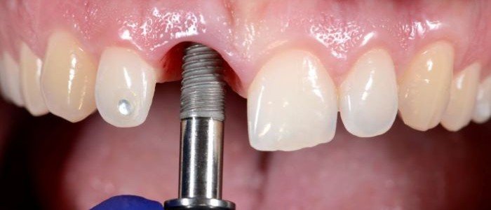 TOOTH EXTRACTION & IMPLANT – SAME-DAY SOLUTION
