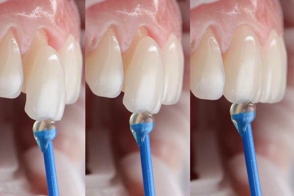 SMILE WITH DENTAL VENEERS