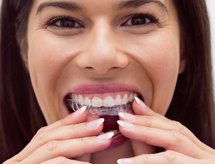 Clear Aligners at Studio Dentale