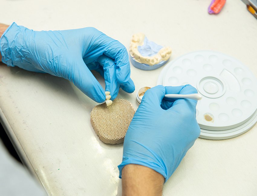 Dental Bridges at Studio Dentale