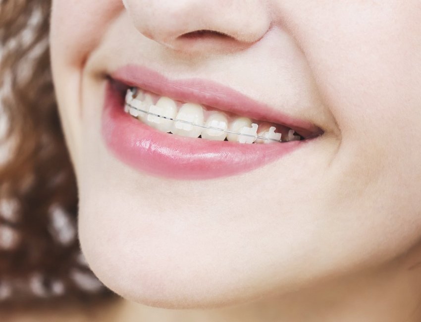 Ceramic Braces at Studio Dentale
