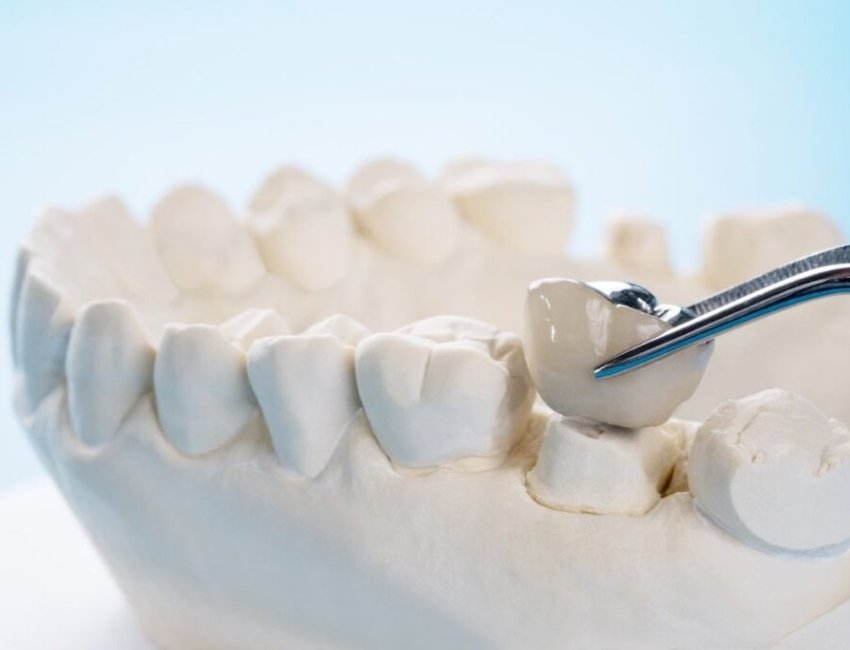 Dental Crowns at Studio Dentale