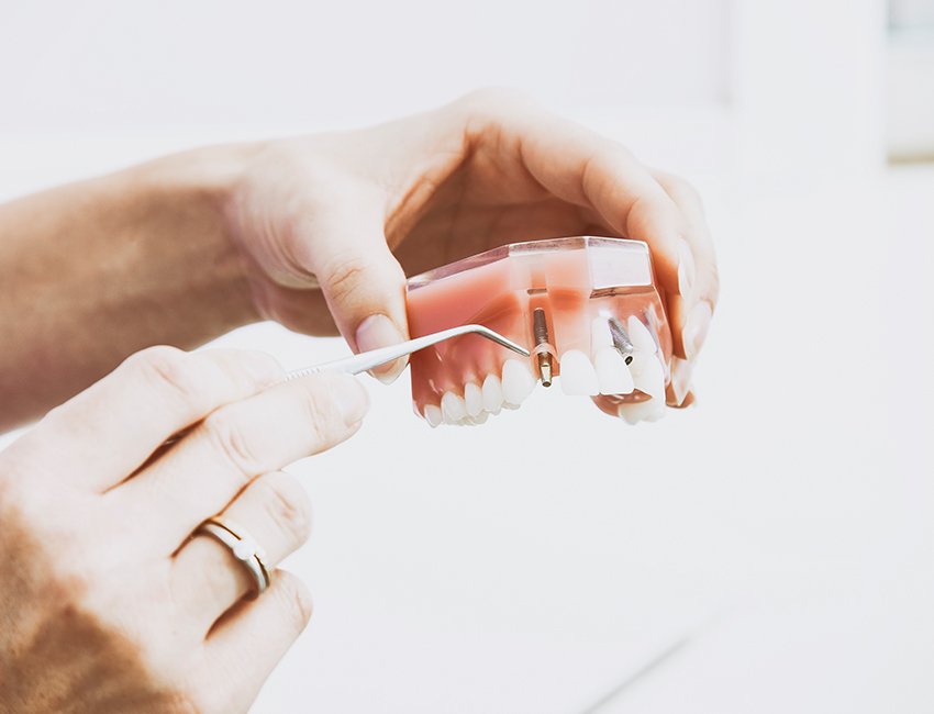 Dental Implants at Studio Dentale