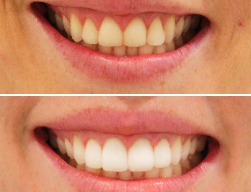 Gum Contouring at Studio Dentale