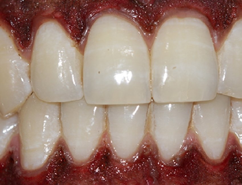 Gum Disease Treatment at Studio Dentale