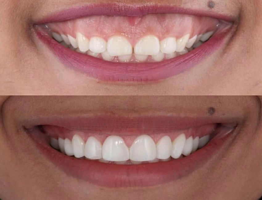 Laser-Assisted Gum Surgeries at Studio Dentale