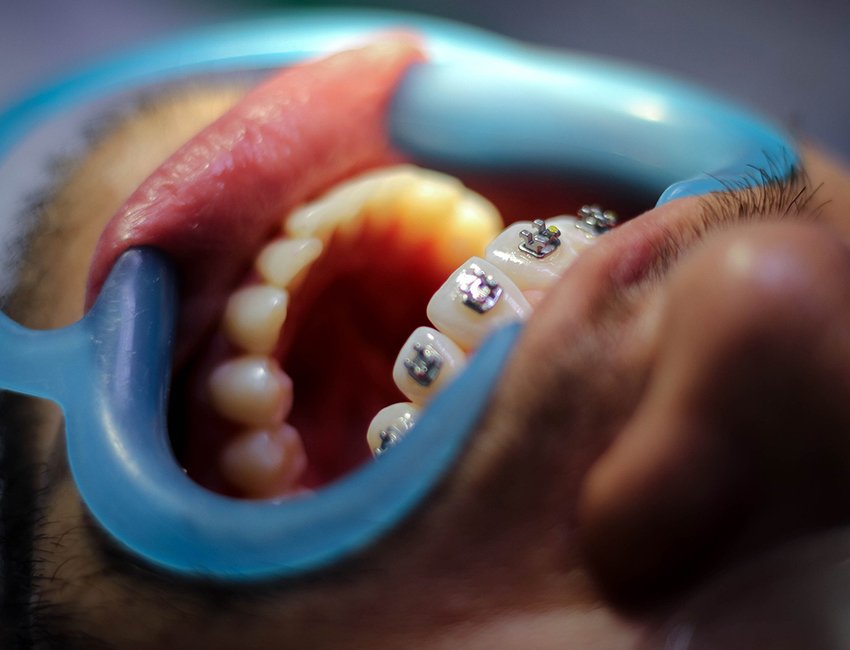 Metal Braces at Studio Dentale
