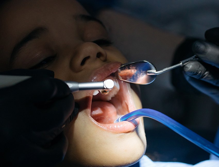Oral Prophylaxis at Studio Dentale