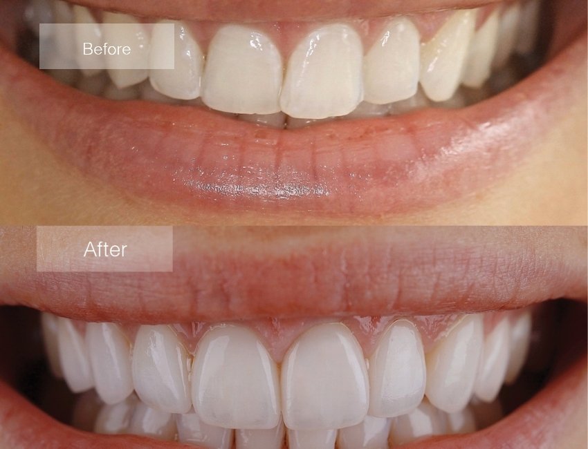Porcelain Veneers at Studio Dentale