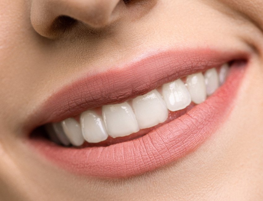 Smile Makeover at Studio Dentale