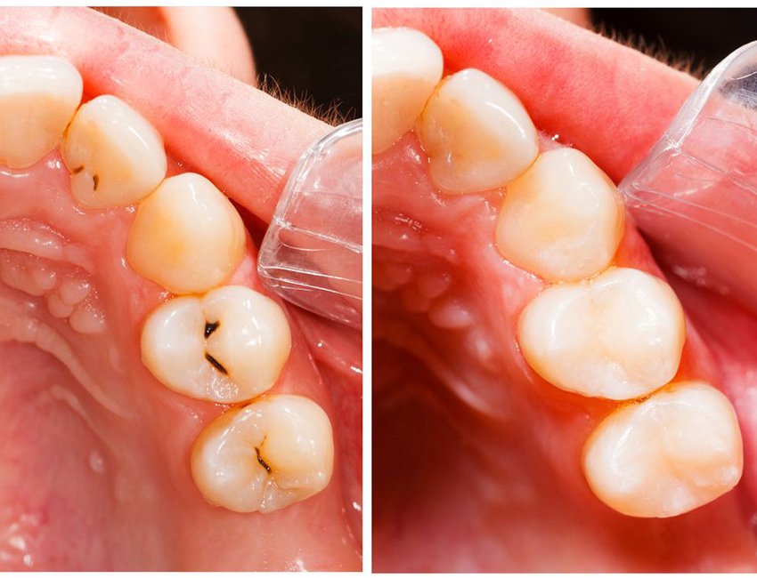 Tooth-Colored Fillings at Studio Dentale