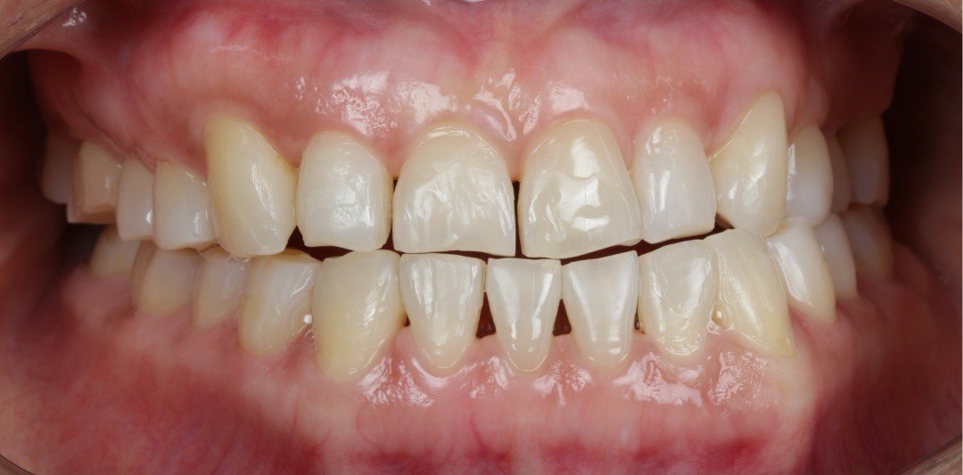 Before smile transformation