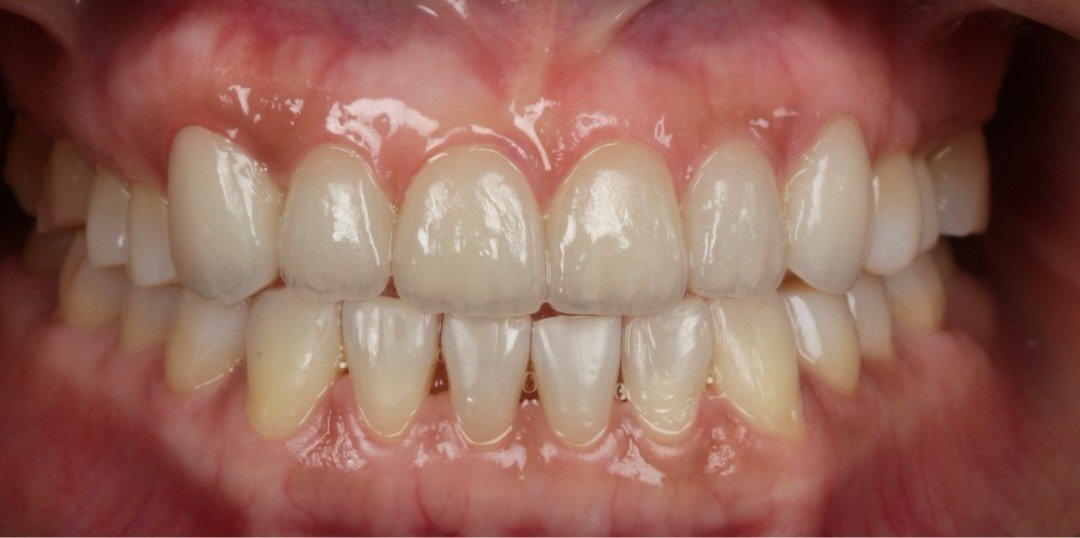 After smile transformation