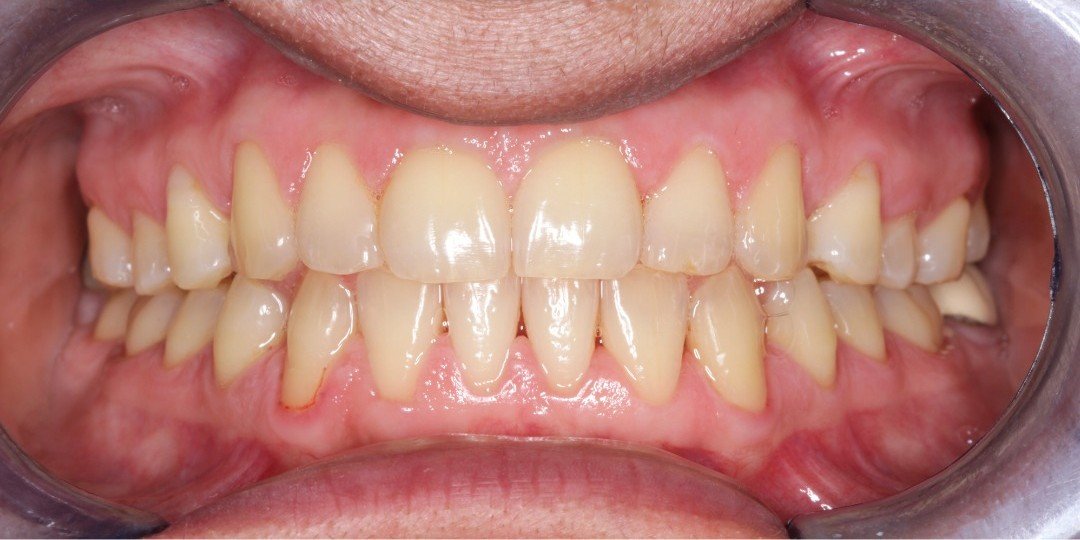 After transformation