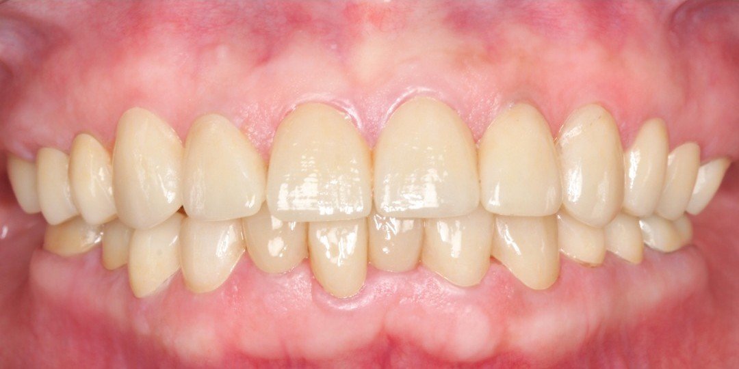After transformation