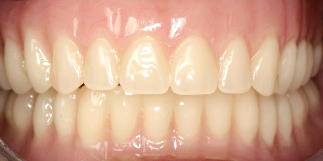 After smile transformation