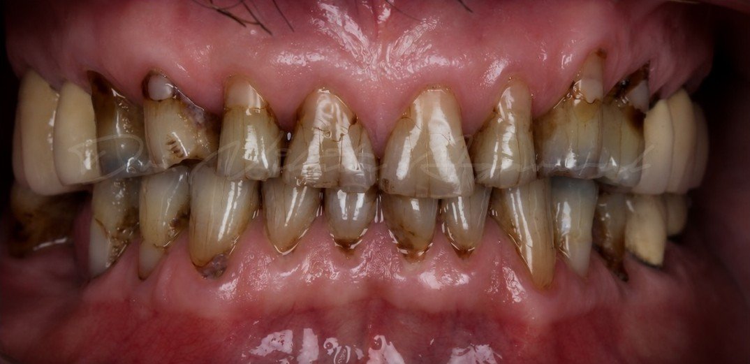 Before smile transformation