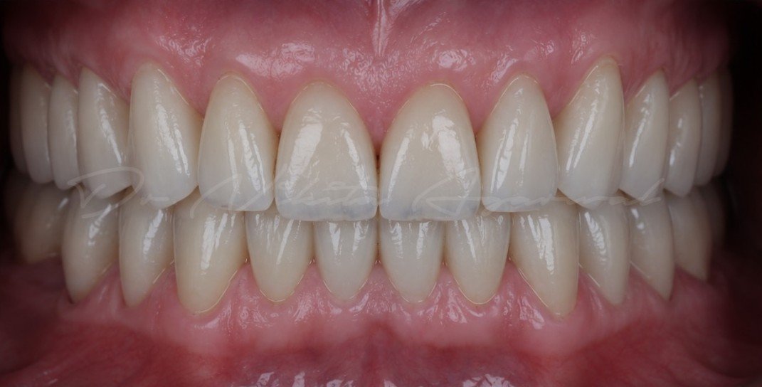 After smile transformation
