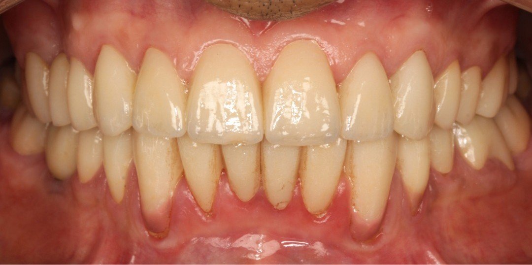 After smile transformation