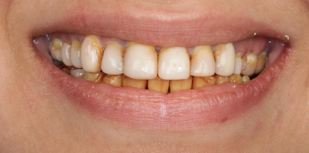 Before smile transformation