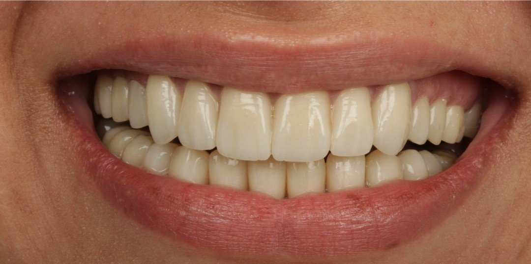 After smile transformation
