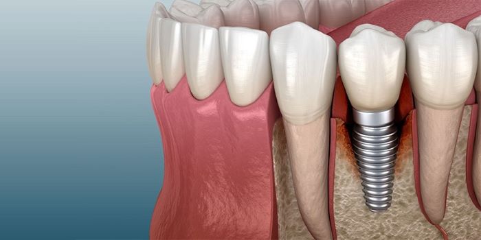 Dental implants