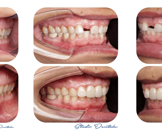 Dental Implants In Kathmandu, Nepal