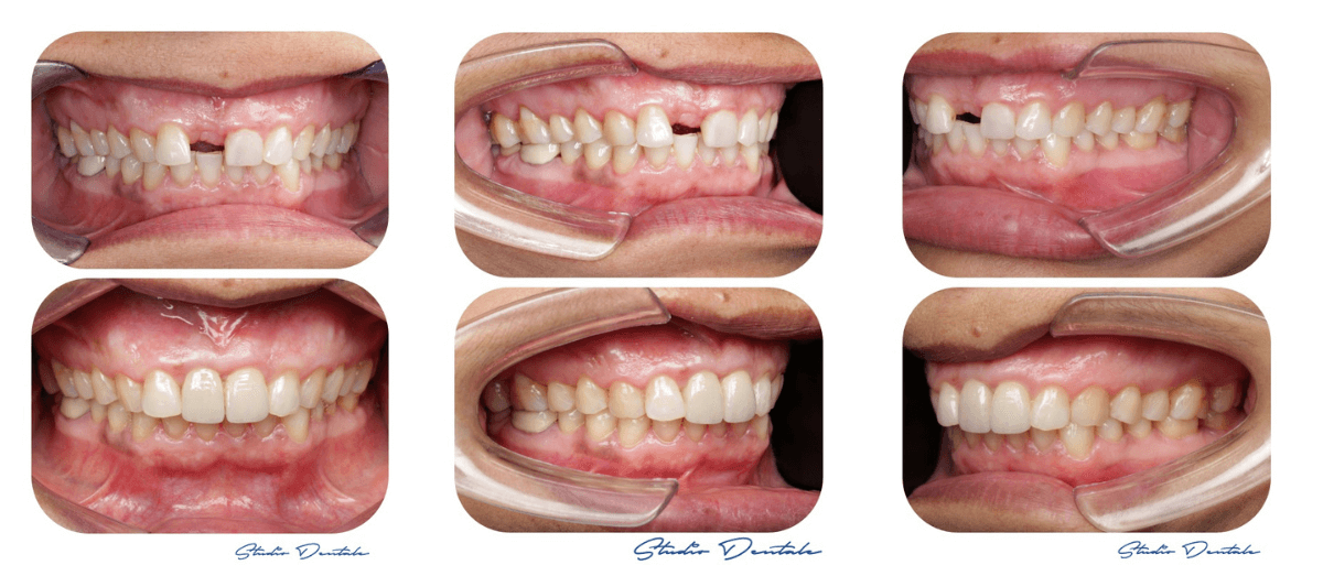 Dental Implants In Kathmandu, Nepal