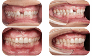 Dental Implant Before After