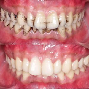 plaque on teeth before and after